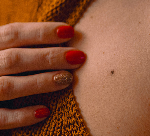 A radiation mark tattooed on skin